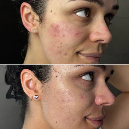 l carnitine acne reddit Meet Sulfur 10% Powder-to-Cream When to take glutamine -