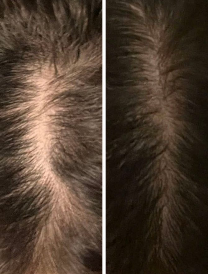 Everything You Need to Know About Female Hair Loss