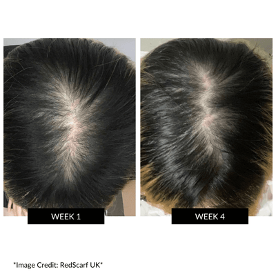 CurrentBody Skin LED Hair Regrowth Device - Affiliate Offer