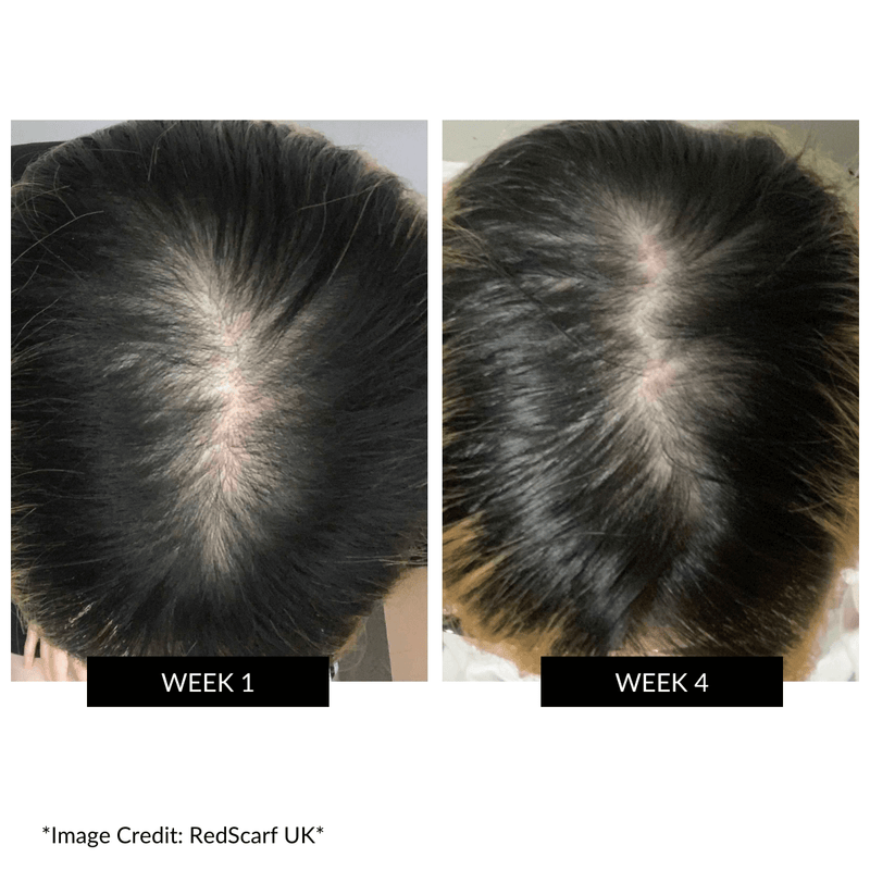 CurrentBody Skin LED Hair Regrowth Device - Affiliate Offer