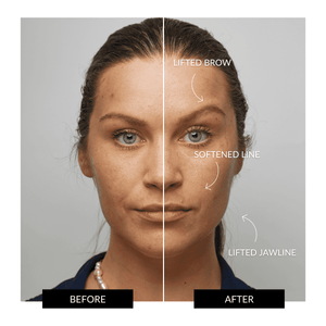 ZIIP HALO Facial Toning Device Offer