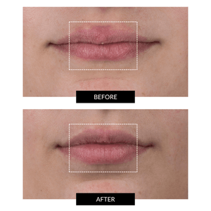 CurrentBody Skin LED Lip Perfector