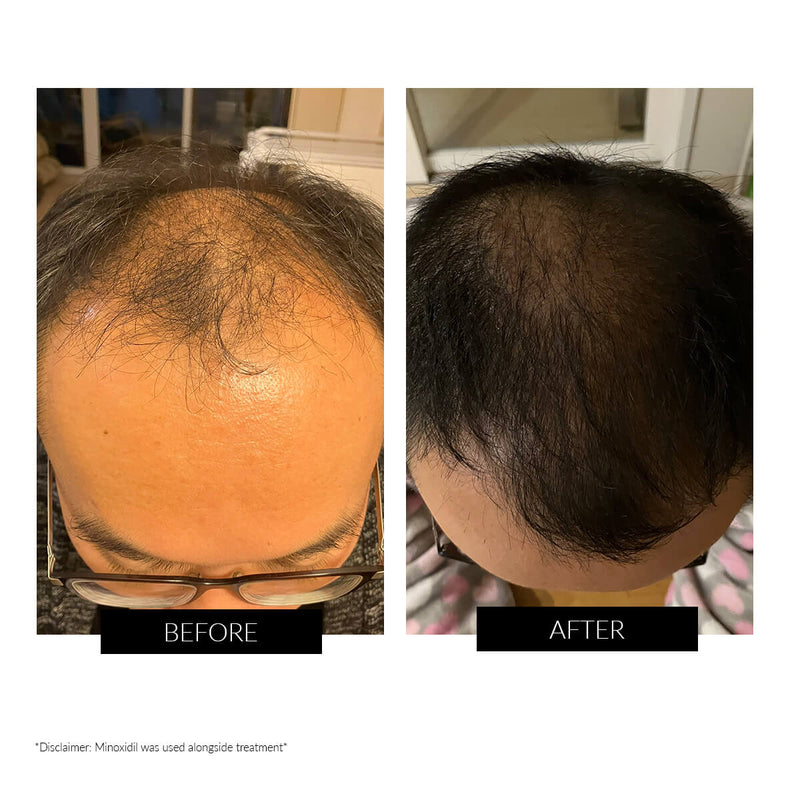 CurrentBody Skin LED Hair Regrowth Device - Affiliate Offer