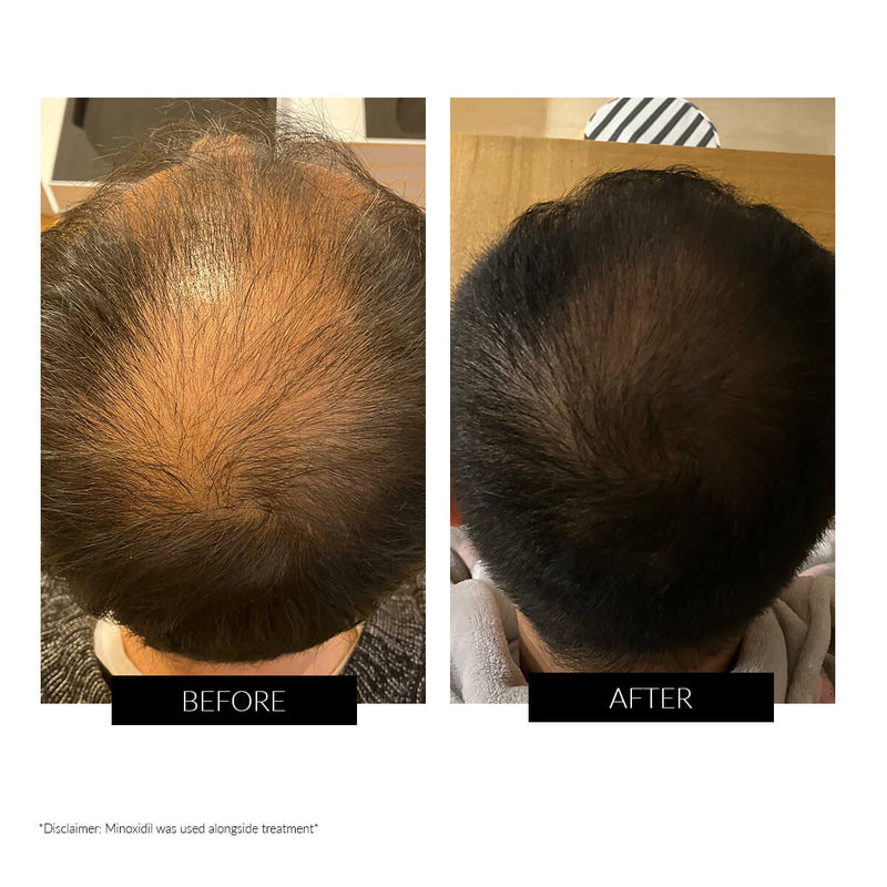 CurrentBody Skin LED Hair Regrowth Device - Affiliate Offer