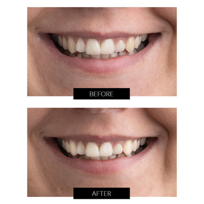 CurrentBody Skin Teeth Whitening Kit Offer