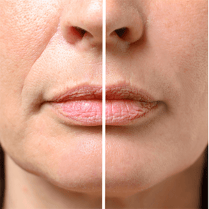Mira-Skin Ultrasound Anti Ageing Tool
