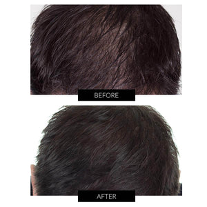 CapillusPro Hair Regrowth Laser Cap