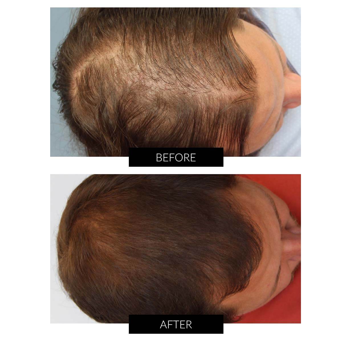 CapillusUltra Laser Cap for Hair Regrowth CurrentBody AU