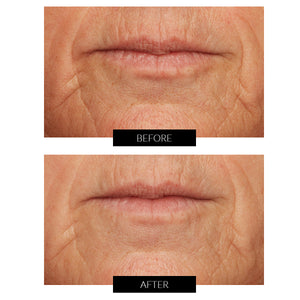 Lancer Skincare Pro Polish Microdermabrasion Device